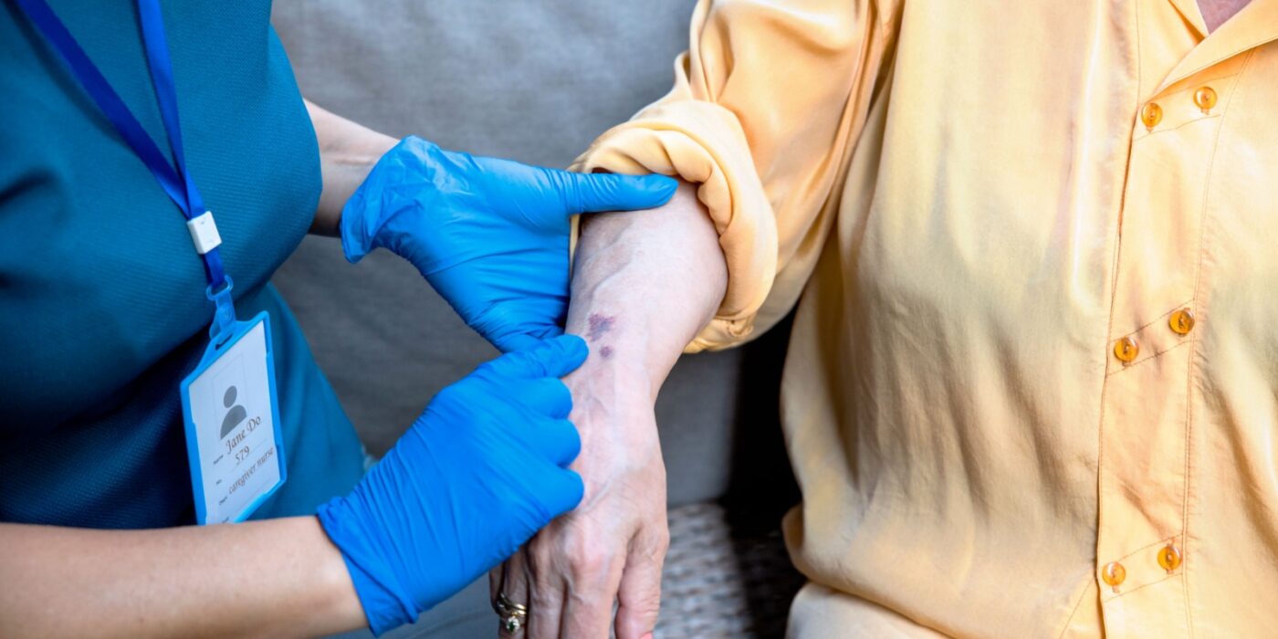 A nurse examines a bruise on an older adult's arm.